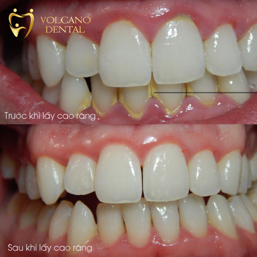 NHỮNG ẢNH HƯỞNG CỦA CAO RĂNG ĐẾN SỨC KHỎE RĂNG MIỆNG? Lấy cao răng