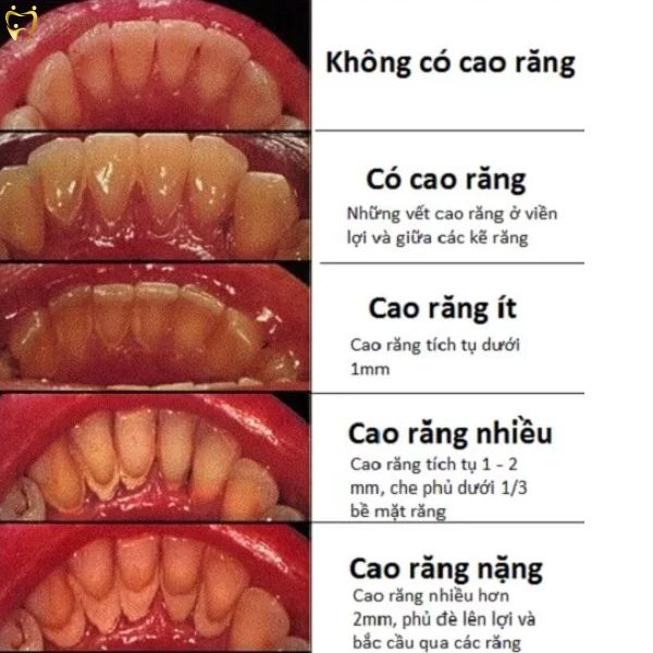 LẤY CAO RĂNG ĐỊNH KỲ GIÚP BẢO VỆ SỨC KHỎE RĂNG MIỆNG HIỆU QUẢ