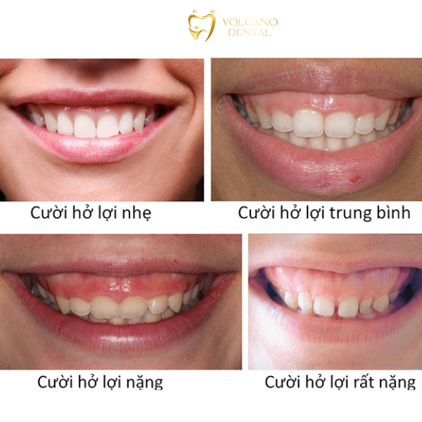 Điều trị cười hở lợi tại Dĩ An Bình Dương Cười hở lợi
