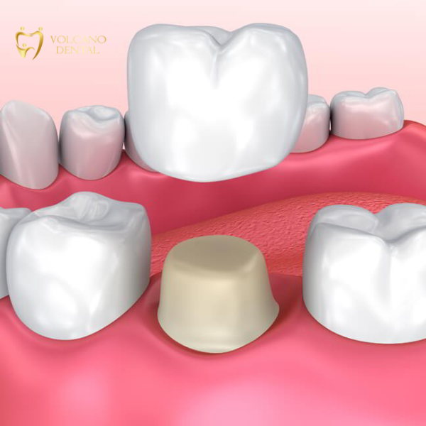 Phục hồi răng