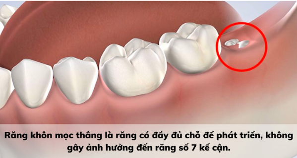 nhổ răng