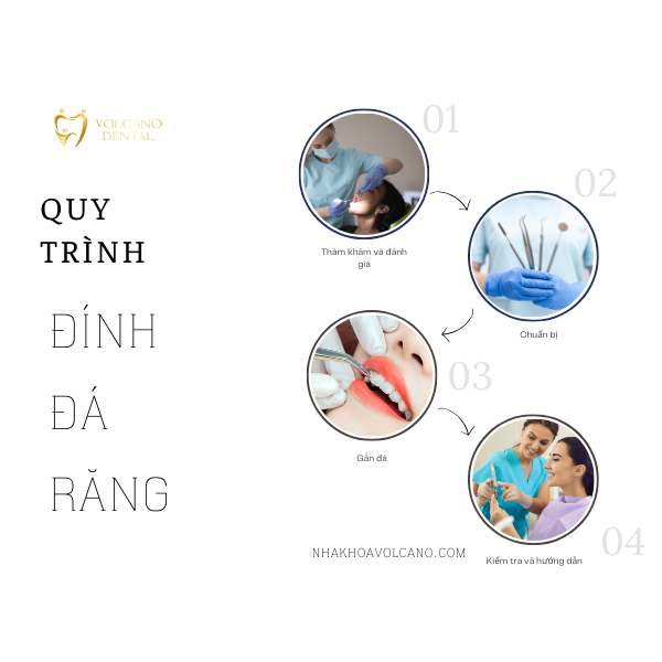 5 ĐIỀU CẦN BIẾT TRƯỚC KHI QUYẾT ĐỊNH ĐÍNH ĐÁ LÊN RĂNG đính đá