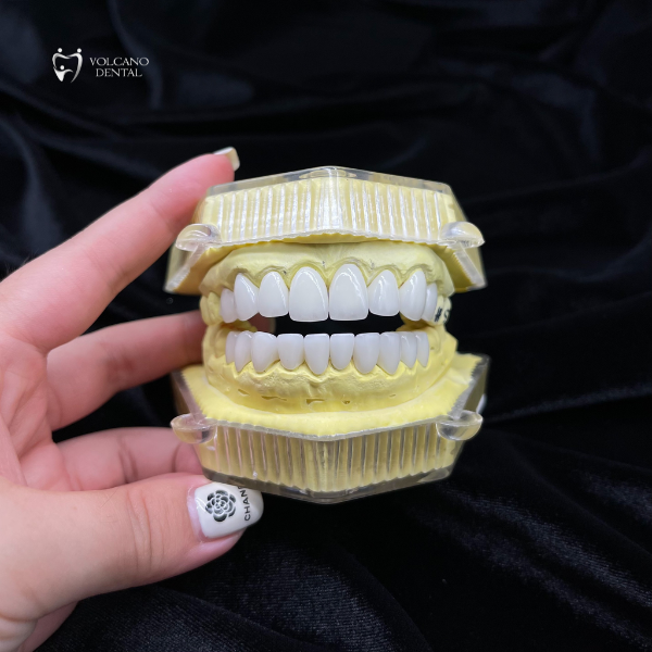 RĂNG SỨ CERCON HT LÀ GÌ? ƯU NHƯỢC ĐIỂM VÀ GIÁ THÀNH? Sứ Cercon HT