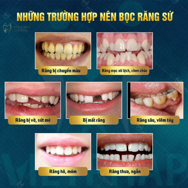 Răng sứ Orodent