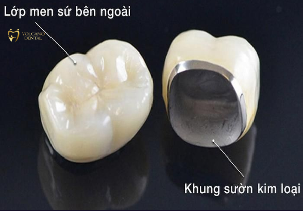 Răng sứ