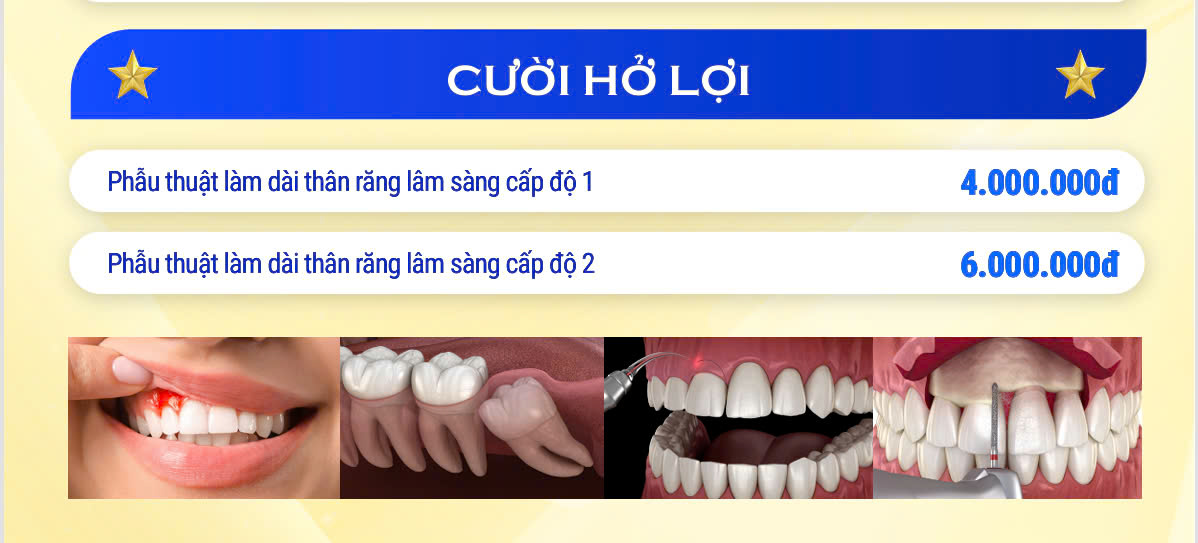 Cười hở lợi