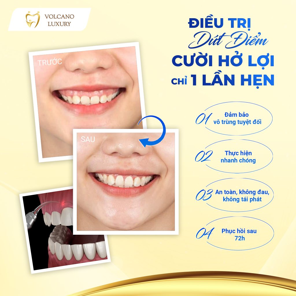 cười hở lợi