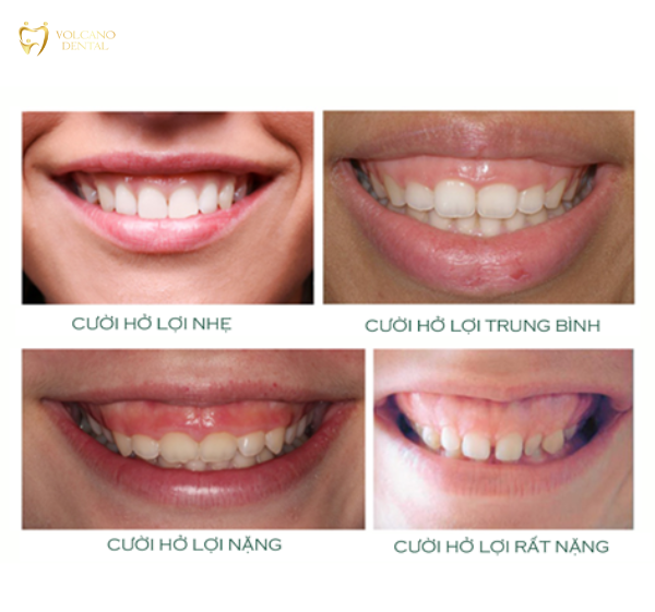 cười hở lợi