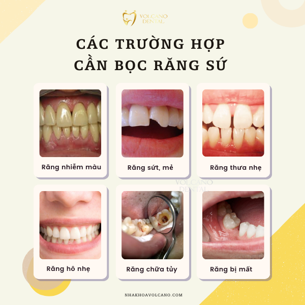 Bọc răng sứ