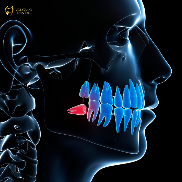 NHỮNG BIẾN CHỨNG CÓ THỂ GẶP SAU KHI NHỔ RĂNG KHÔN? răng khôn