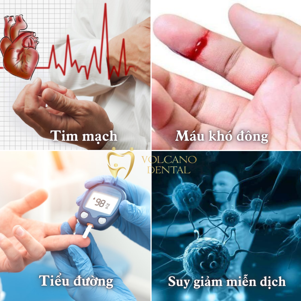 Răng khôn