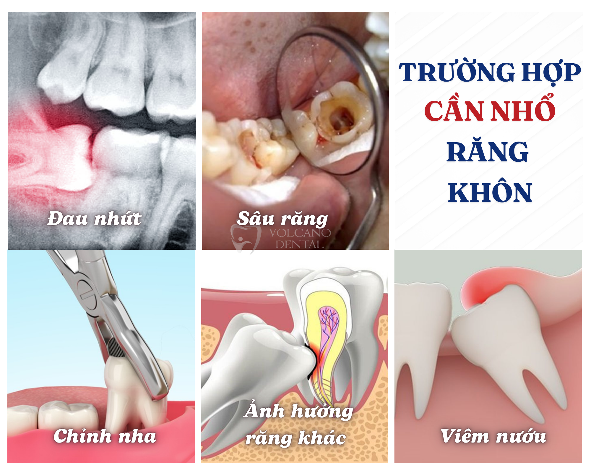 Răng khôn